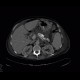 Chronic pancreatitis, calcified, nasojejunal tube: CT - Computed tomography